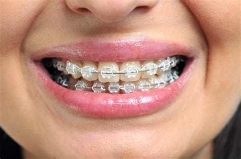 ceramic brackets vs metal brackets|ceramic braces before and after.